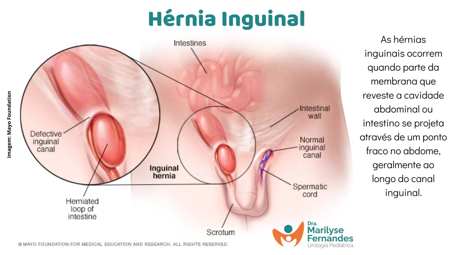 Hérnia inguinal infantil: como identificar e procurar ajuda