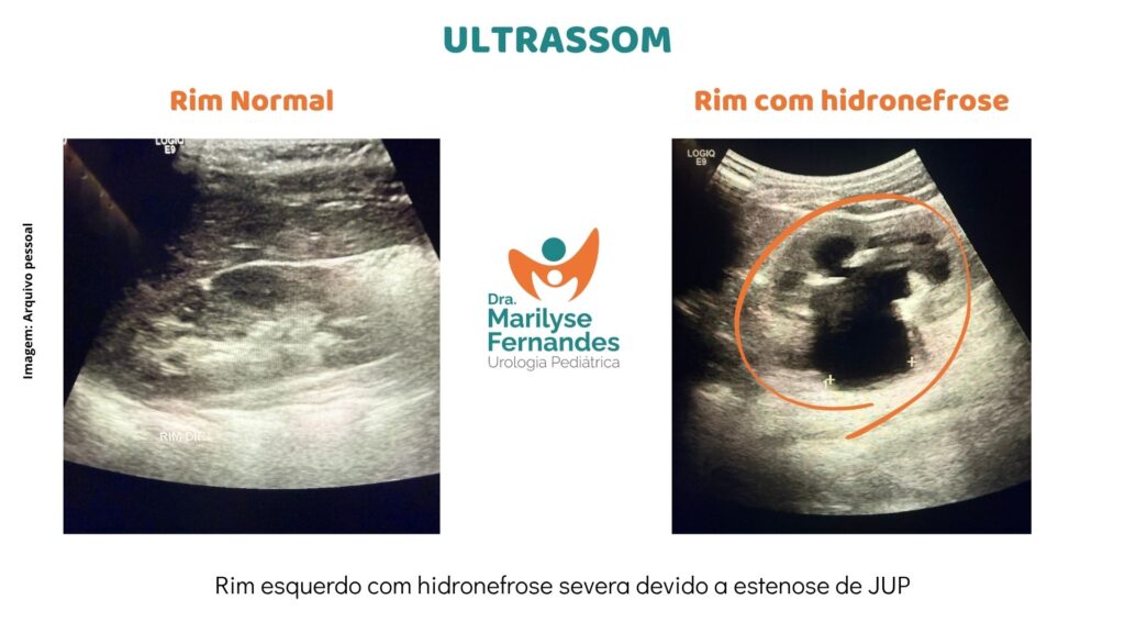 Ultrassom trato urinário